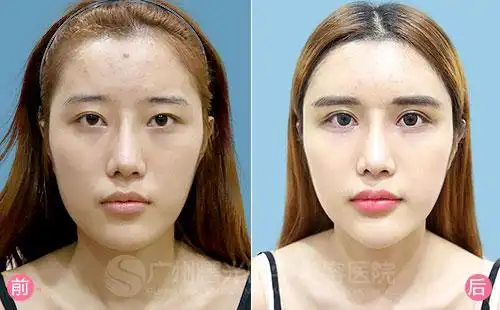 李柯——韩式双眼皮前后对比