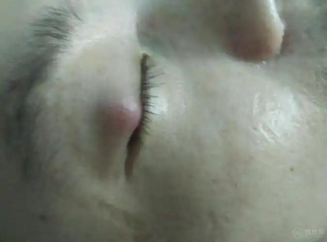眼皮处长了个疙瘩,开始几天疼,后来不疼了,现在变成了红色.