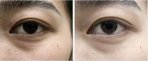 这个"眼部烫斗"真的可以烫平眼部皱纹吗?