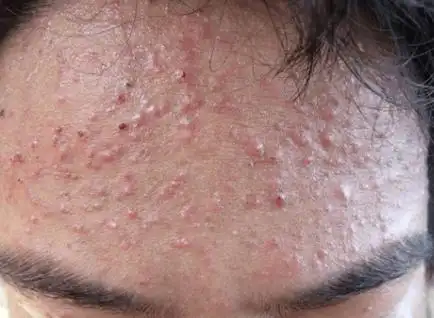 怎样才能迅速,准确地辨别出痘痘与毛囊炎?