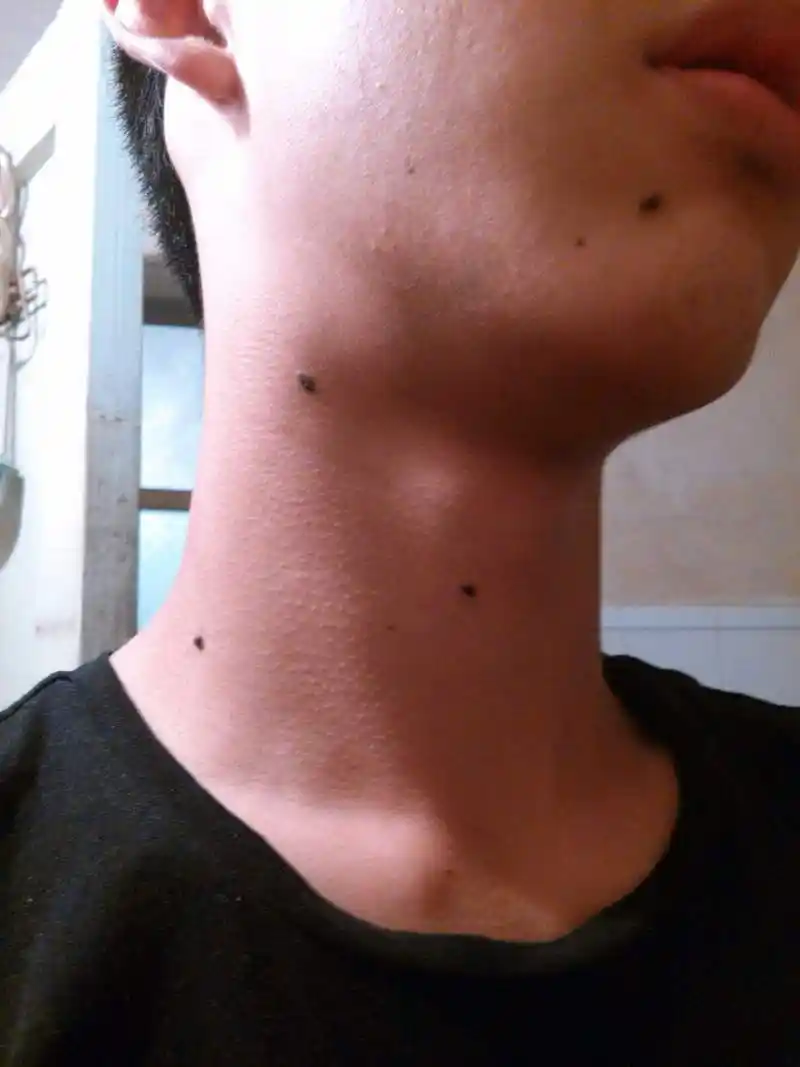 脖子长痣看命运,象征一生有靠山,能飞黄腾达的苦情痣,你有吗?
