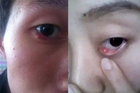 【图】发现眼睛长了麦粒肿怎么办 知晓这些让你不再担心