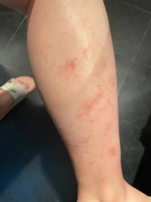 小腿红疹子终于缓解了