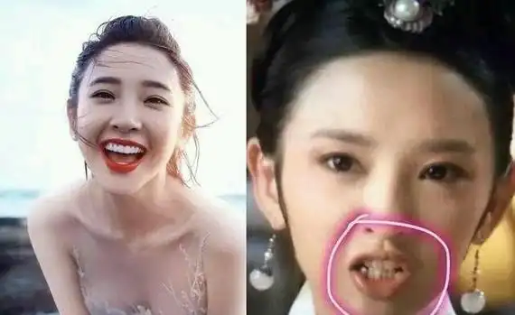 里看到很多人有凸嘴问题,有牙性原因的,都需要整牙,深覆合,地包天等等