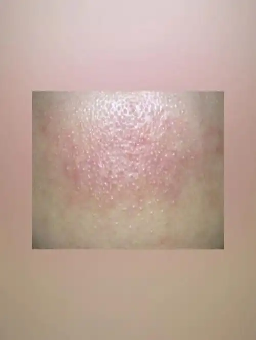 由皮脂堆积在毛孔里而形成的,他和痘痘不同是闭口大多出现在额头部位