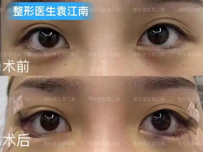 下至外眼角术后即刻