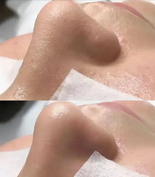 为什么这么多人疯狂的跑美容院做"毛孔清洁",真的能去黑头吗?