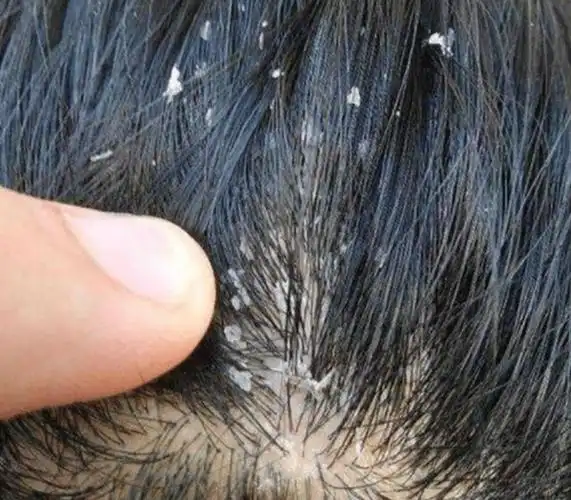 头皮屑大块掉极有可能长了一种癣治癣2秘方杀菌就能好