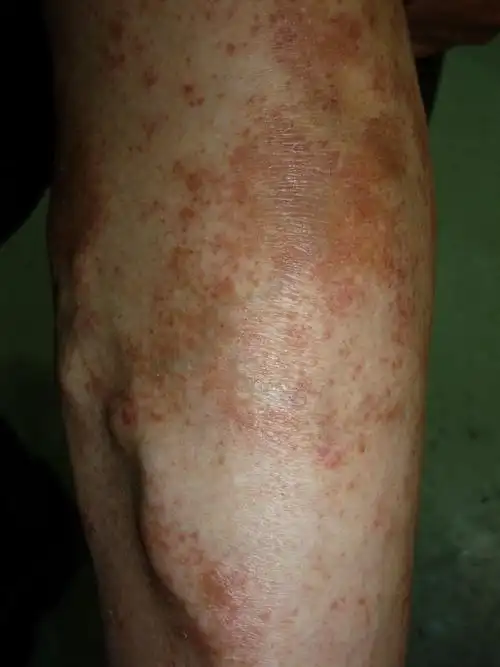 病例讨论小腿红斑