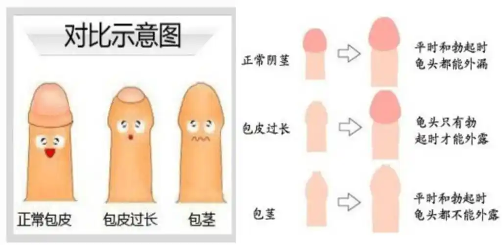 包茎——包皮割与不割,是个问题!