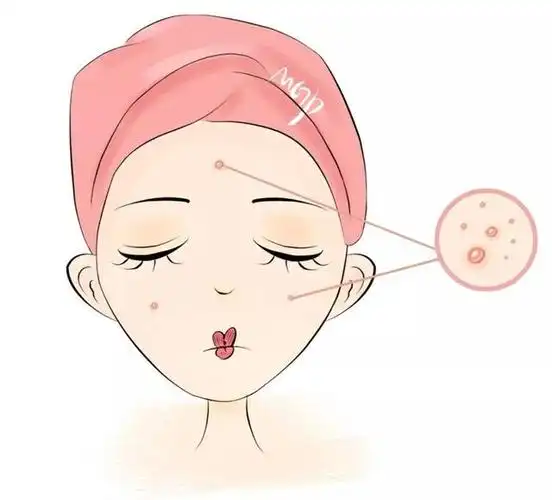 女孩长痘被称"痘花妹",自信受损,正确的祛痘方式是什么?