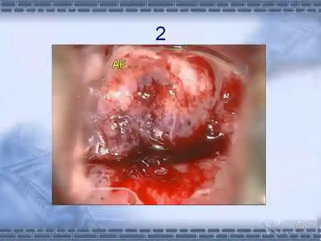 精彩幻灯宫颈癌36个典型病例宫颈图像详解