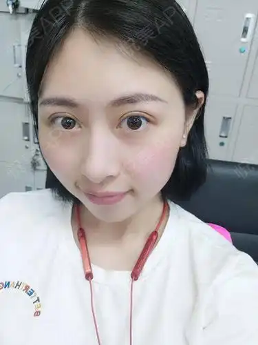 全切双眼皮术后25天_双眼皮术后25天_眼部整形术后25天_离情几度分享