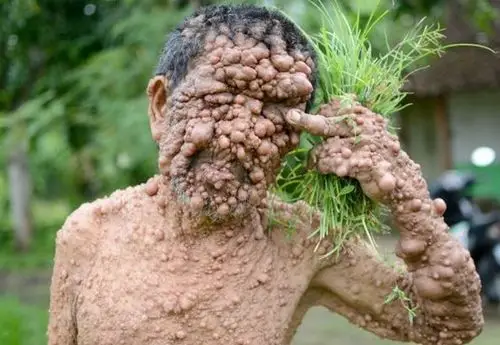 90后女孩8年拔光头发细数全球各种罕见怪病