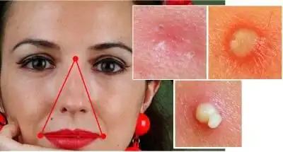 脸上有个「三角禁区」很危险,长任何东西都不能随便处理.