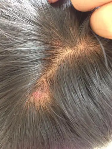 头皮一块反复结痂凸起老是扣(头皮一块反复结痂凸起老是扣,抠掉痂底下