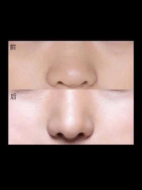 鼻翼宽怎么改善做什么手术