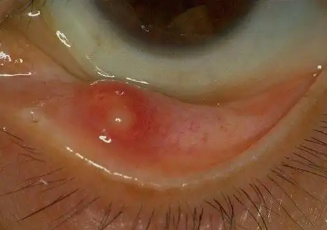 麦粒肿的早期症状包括眼睑触痛,发红和轻度肿胀.