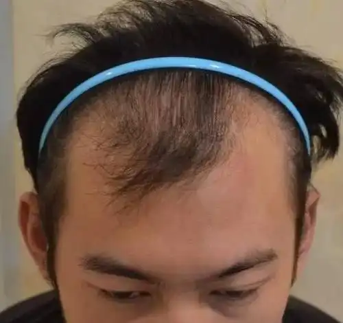 医生证明90后真秃了:"这一代人比他们的父辈脱发来得要早"