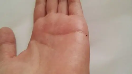 女,左手侧面感情线末端新长出一个痣,命理上有什么意义吗?