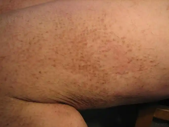 图片1-苔藓样皮肤淀粉样变