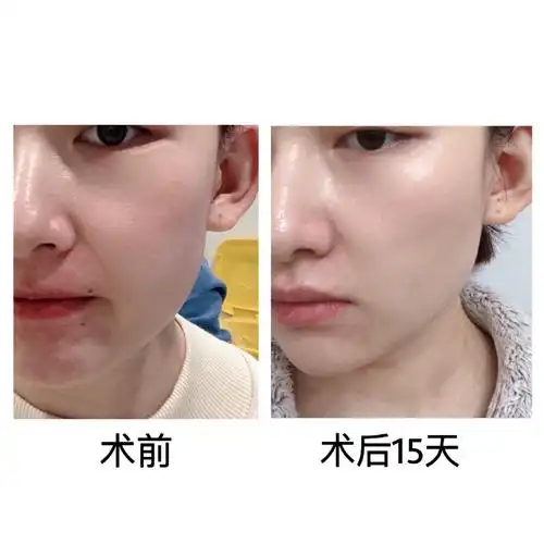 碧萃诗长效水光补水术后15天对比