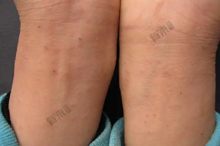 手腕疥疮图