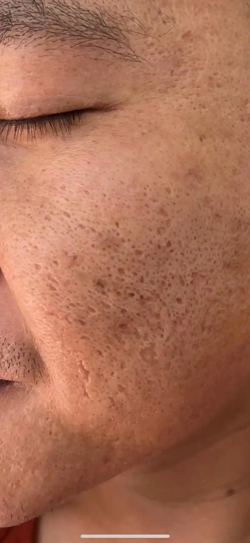 痘坑痘印一次笑果