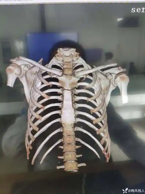 肩锁关节脱位注意脱位方向