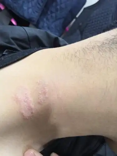 脖子上长了两条红印,像癣那种