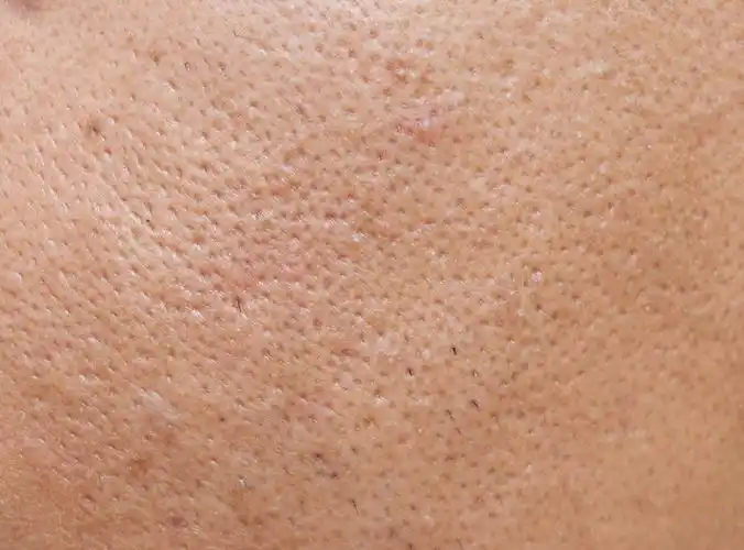 毛孔粗大如何缓解?一定要注意这几点!_皮肤