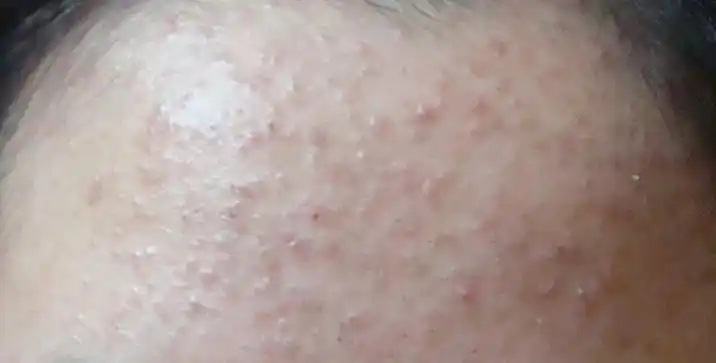 关于额头上的真菌性毛囊炎