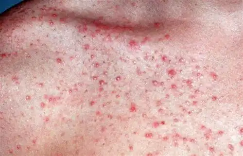 臀部毛囊炎症状图片