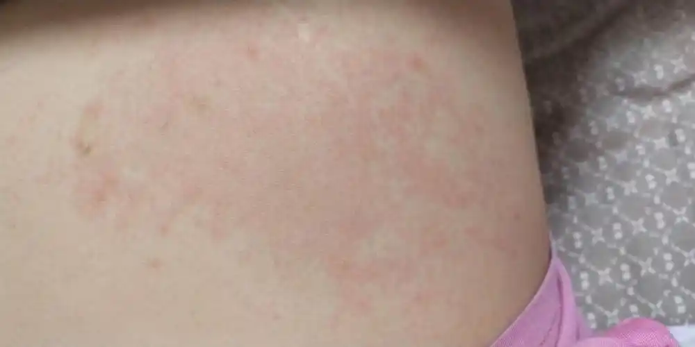 孕中期肚子上长了大片红斑,有点痒,这是怎么回事