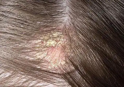 头皮上有大块头皮屑还有结痂症状图片及原因怎么治