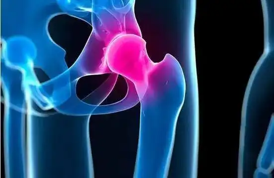 目前股骨头坏死早期的症状大部分的表现