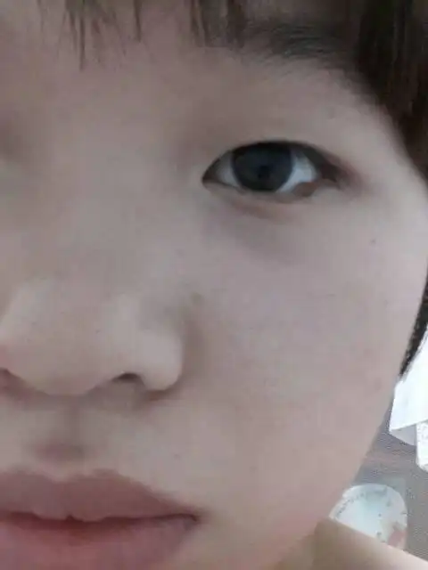 我是一名22岁女生,左眼下眼睑眼尾处有一颗凸出的黑痣 ,是天生的,随着