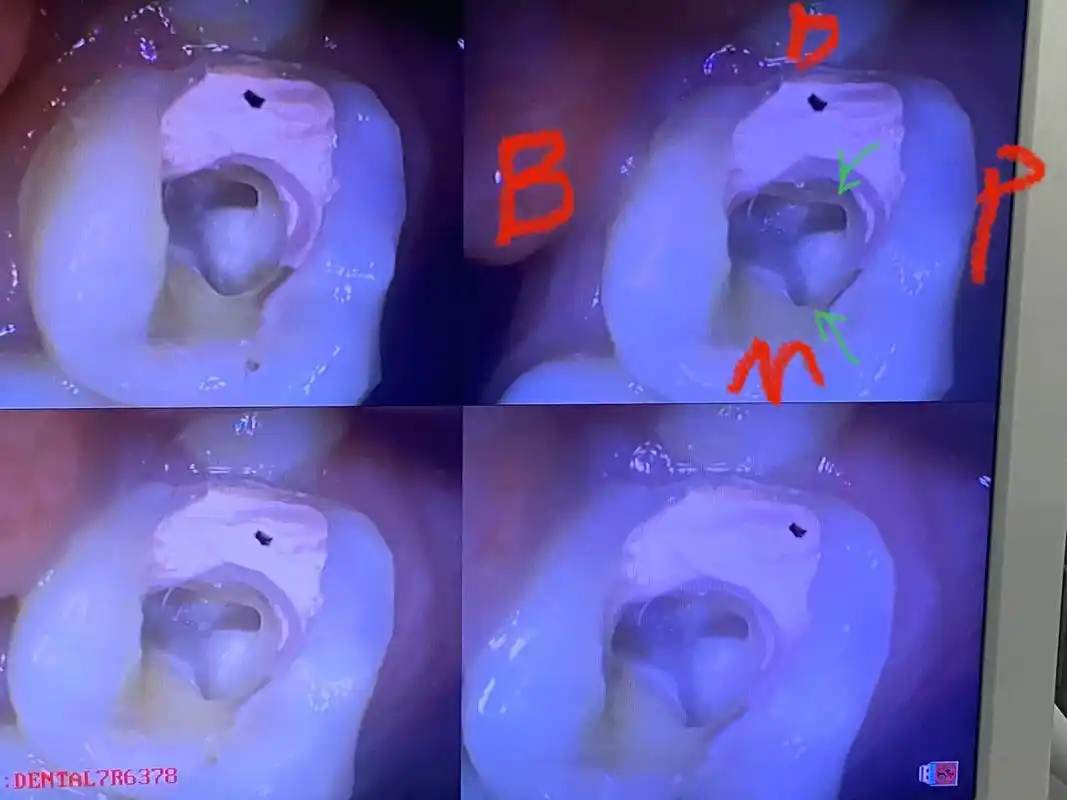 罕见的上颌第二磨牙舌侧双根双根管
