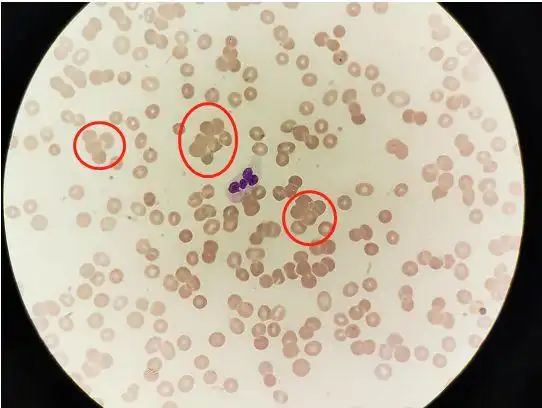 无法纠正的红细胞凝集结果到底该如何发