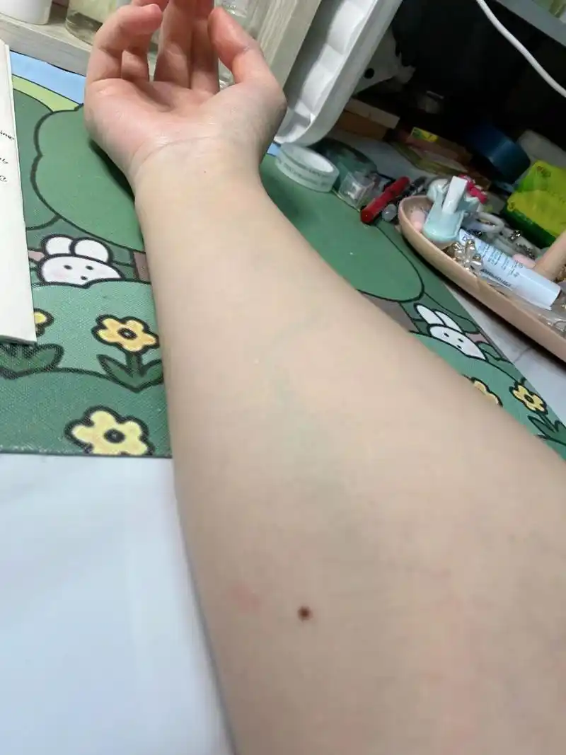 胳膊上突然长了个痣 因为还没到穿短袖的季节,没咋认真观察自己的胳膊
