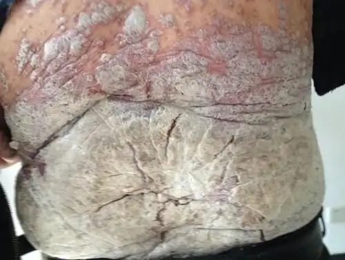 皮肤癣图片百度皮肤病图片识别肚子上长癣图片图库什么是假性银屑病