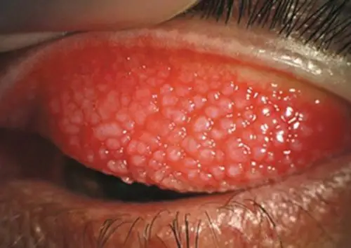 急性的传染性的结膜炎临床的表现的图片_有来医生