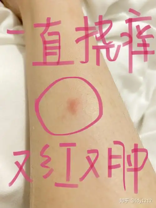 家里有跳蚤怎么去除被跳蚤咬怎么止痒