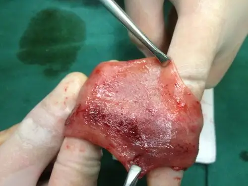 直肠脱垂行pph术