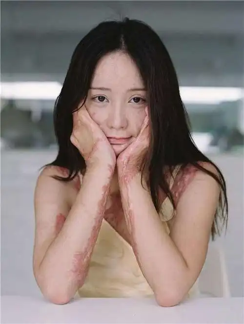 五年前拒绝官二代追求的少女惨遭拨油点火毁容,如今