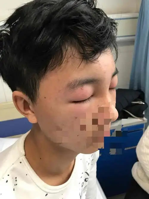 小于400毫升,门诊检查尿蛋白 3,血白蛋白仅仅17克,初步考虑肾病综合征