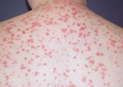 点滴状银屑病是一种皮肤状况,其中出现小的,点状的红色斑块:手臂腿