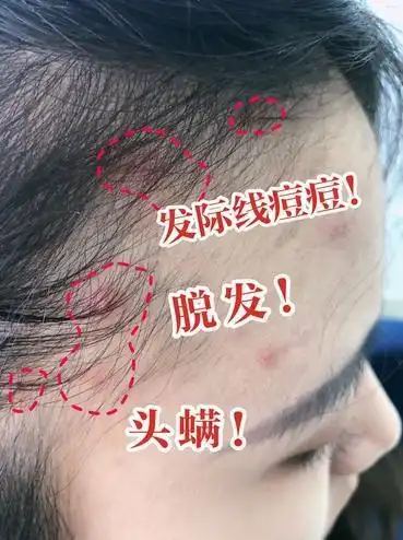 发际线长痘痘可能是头皮有螨虫了看看同时有没有这4个情况