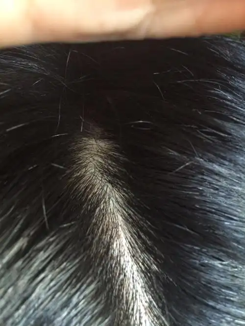 是热症要怎么治疗? 麻烦各位专家请指点一下我该怎么办.