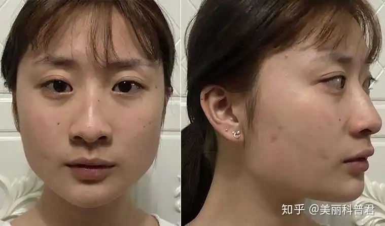 因为方脸 脸宽 下颌骨肥大而自卑怎么办 该不该削骨? - 知乎
